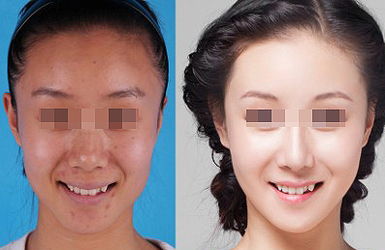 熱拉提的治療效果好不好？多久起效？
